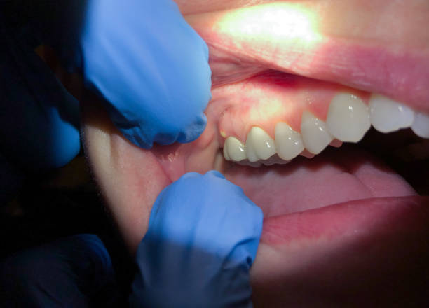Best Emergency Root Canal Therapy in Forest Meadows, CA